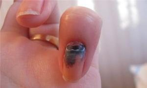 Ушиб ногтя на руке: что делать, признаки и симптомы