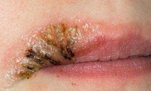 What can be dangerous lip tattoo Poor-quality lip tattoo