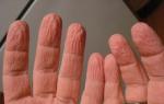 Зморшки на подушечках пальців рук - рецепти найефективніших домашніх масок Чому розбухають пальці на руках у воді