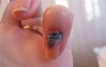 Bruised fingernail: what to do, signs and symptoms